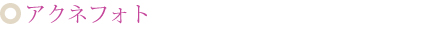 アクネフォト